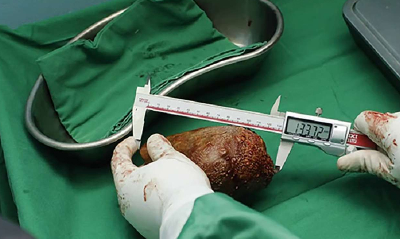 801 gram ağırlığında böbrek taşı