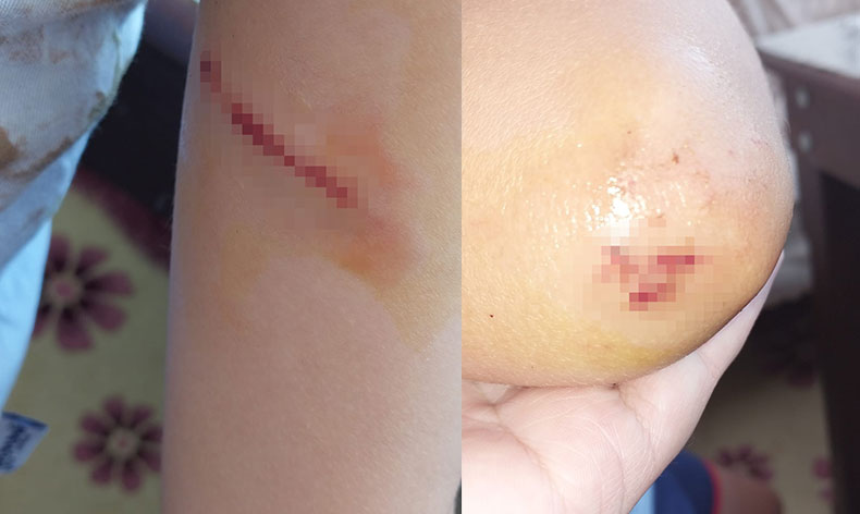 Sokak köpeklerinin saldırdığı çocuk babası sayesinde kurtuldu